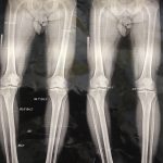 Bracket knee deviation (2)