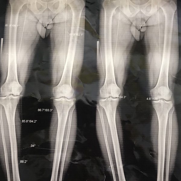 Bracket knee deviation (2)