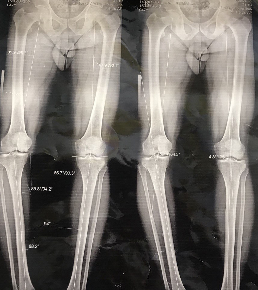 Bracket knee deviation (2)