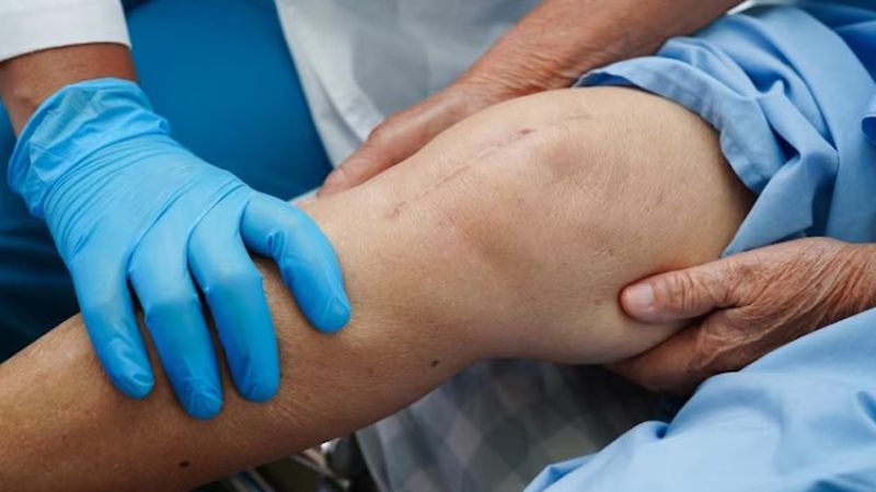 Diz Eklemi Cerrahisi ve Sonrası Bakım