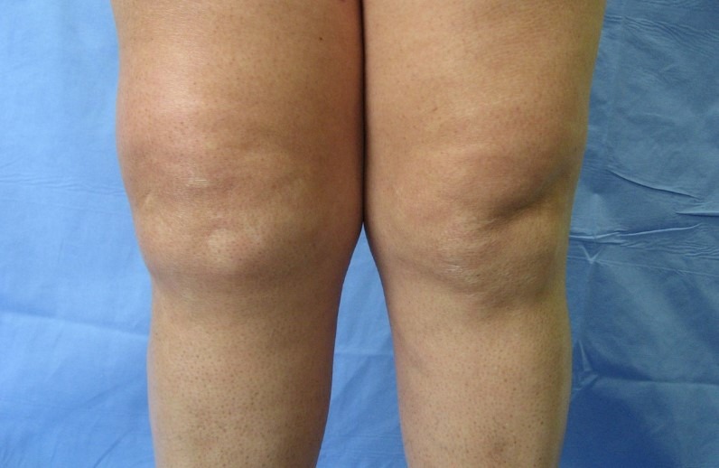 Dizde Sıvı Toplanması