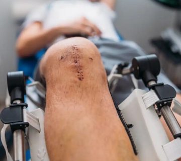 مراقبت بعد از تعویض مفصل زانو