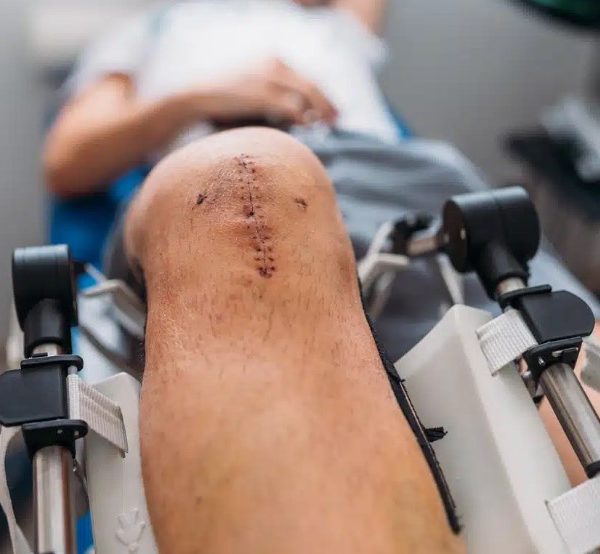 مراقبت بعد از تعویض مفصل زانو