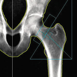 DEXA عکس