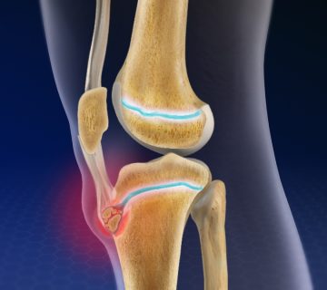 بیماری ازگود شلاتر