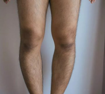 عمل زانوی پارانتزی در تبریز