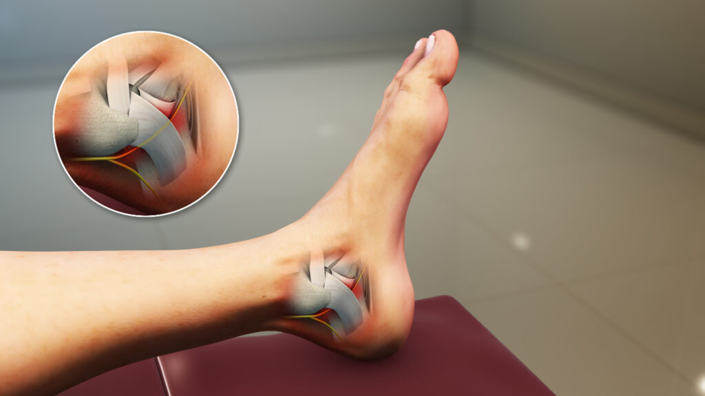 عکس سندرم تونل تارسال