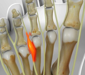 رفع انسدادهای عصبی ارتوپدی