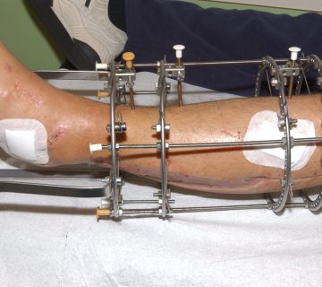 عکس جراحی الیزاروف