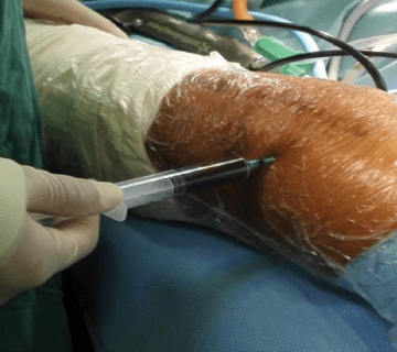 عکس همارتروز زانو