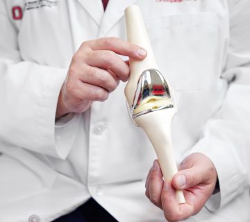 عمر مفصل زانو