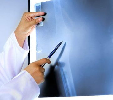 آرتروپلاستی