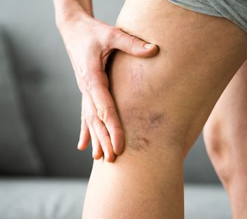 کبودی زانو بعد عمل جراحی