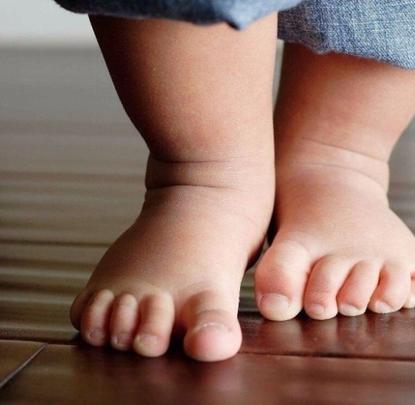 بیماری لگ کالو پرتس